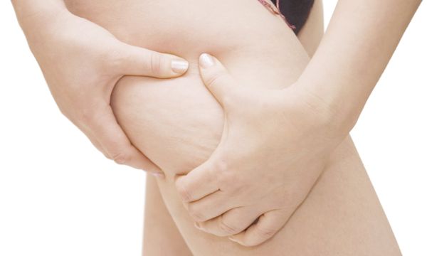Nutrição ajuda a combater a celulite