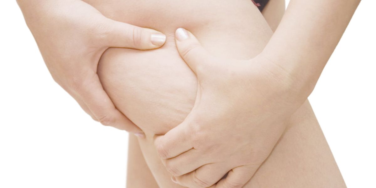 Nutrição ajuda a combater a celulite